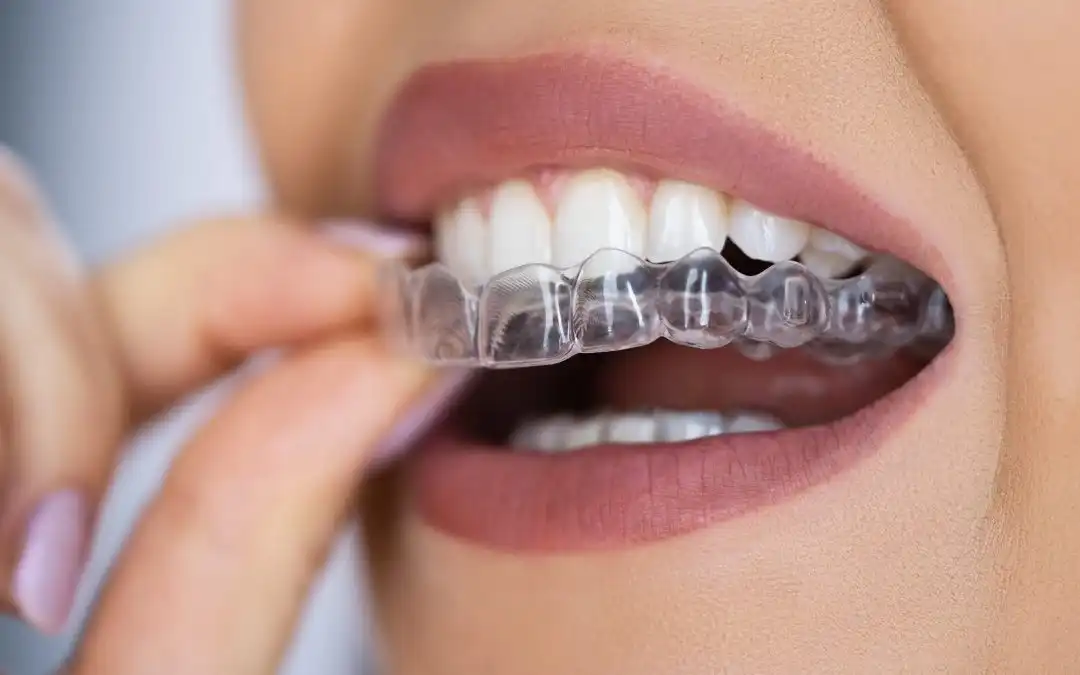 clear-aligners-2